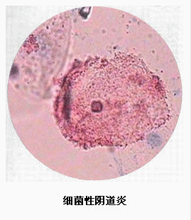 老年性阴道炎