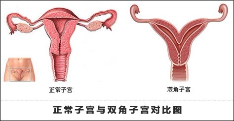 子宫性不孕
