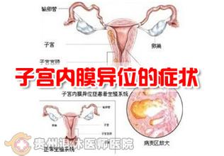 子宫内膜异位