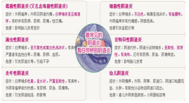 滴虫性阴道炎